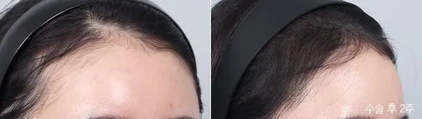 Before/After