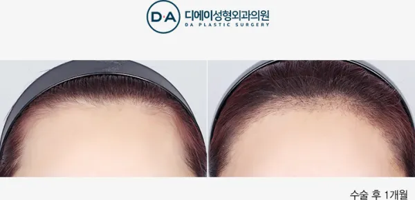 Before/After