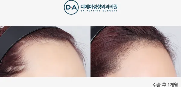 Before/After