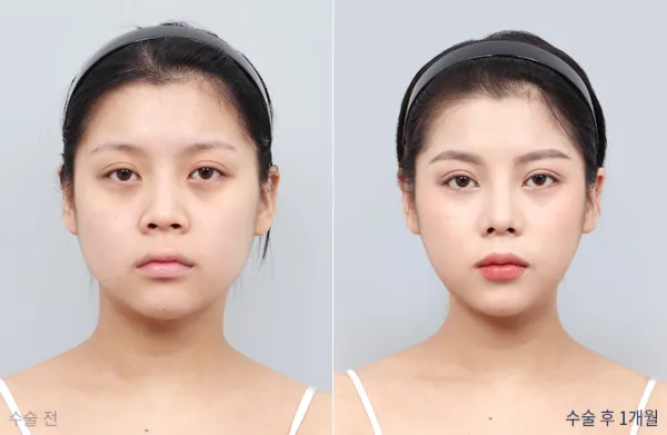Before/After