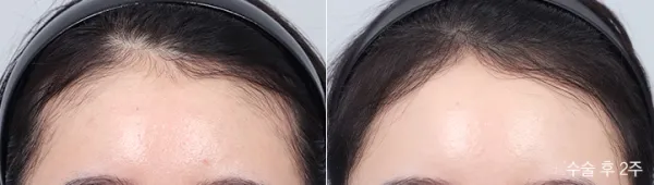 Before/After