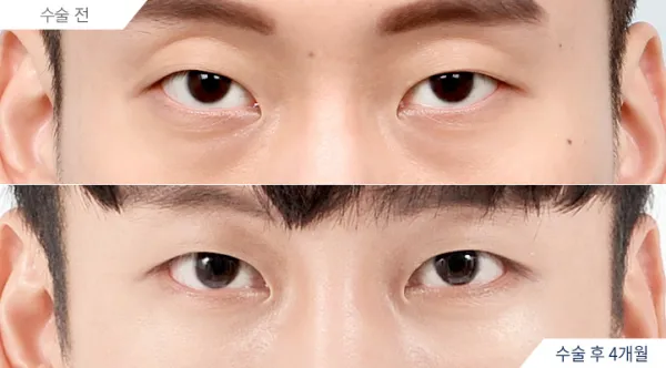 Before/After