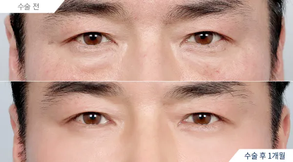 Before/After