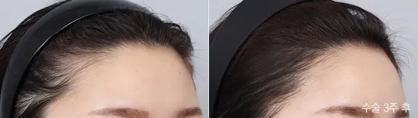 Before/After