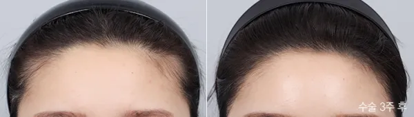 Before/After