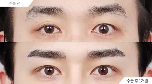 Before/After