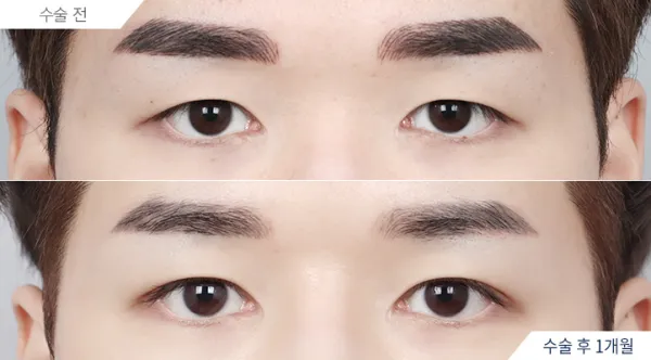 Before/After