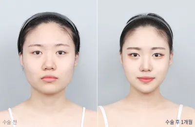 Before & After