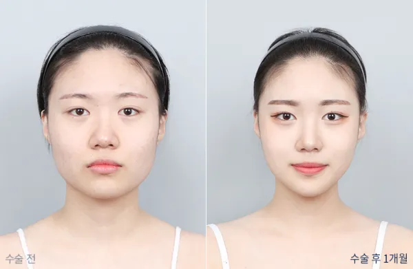 Before/After