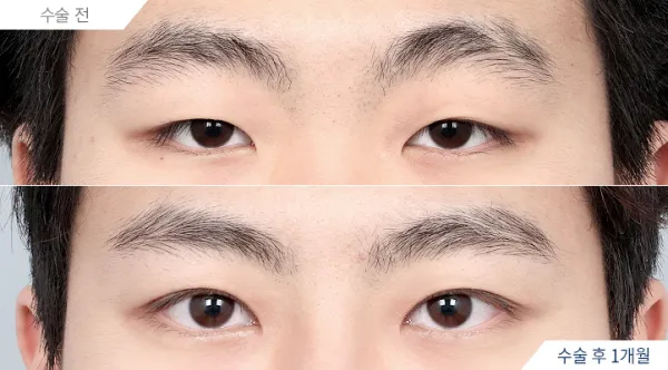 Before/After