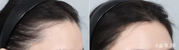 Before/After