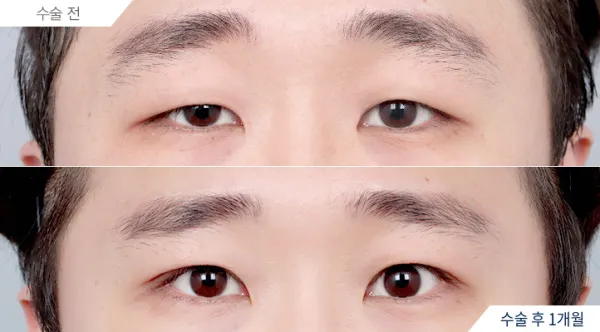 Before/After