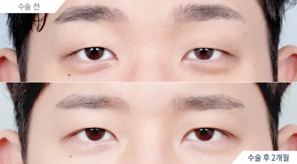 Before/After