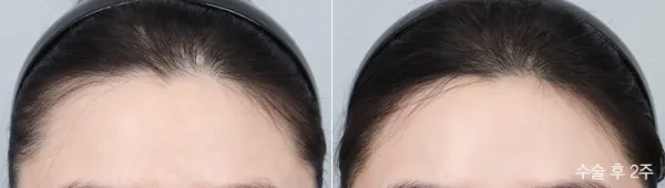Before/After