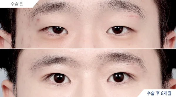 Before/After