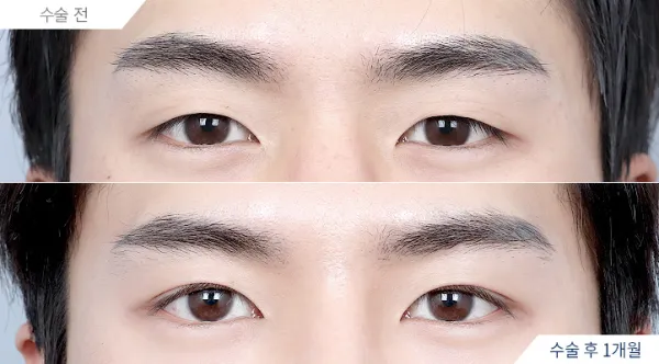 Before/After