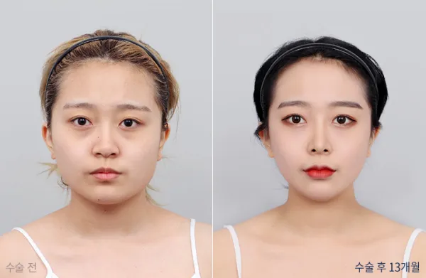 Before/After