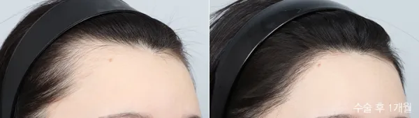 Before/After