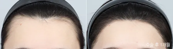 Before/After