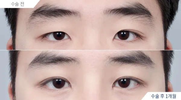 Before/After