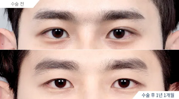 Before/After