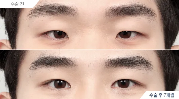 Before/After