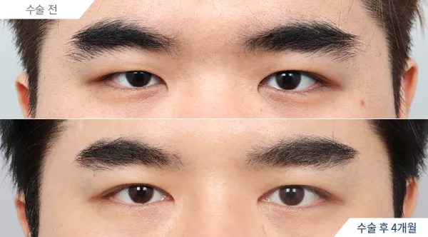 Before/After