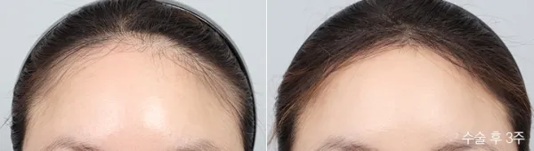 Before/After