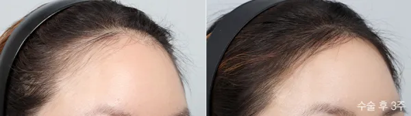 Before/After