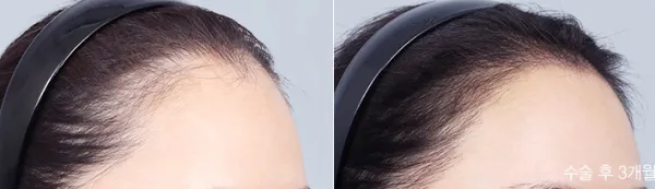 Before/After