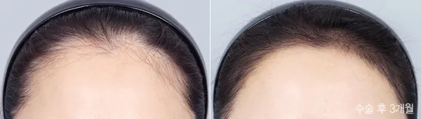 Before/After