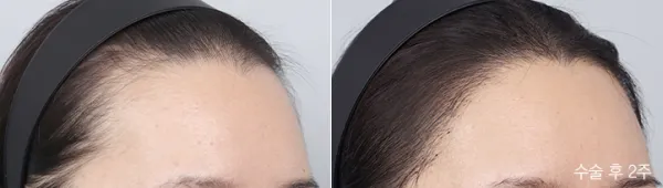 Before/After