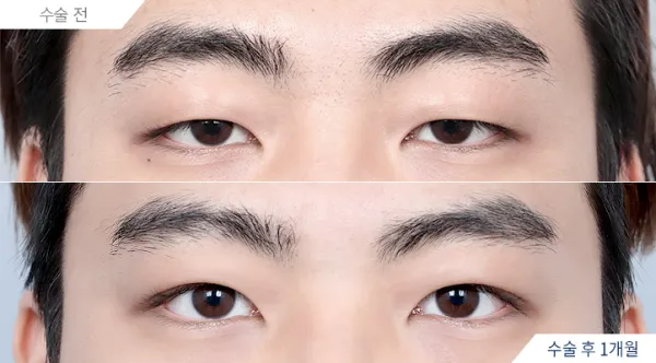 Before/After