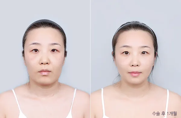 Before/After