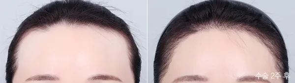Before/After