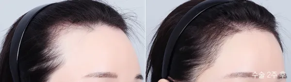 Before/After