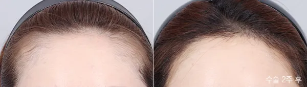 Before/After