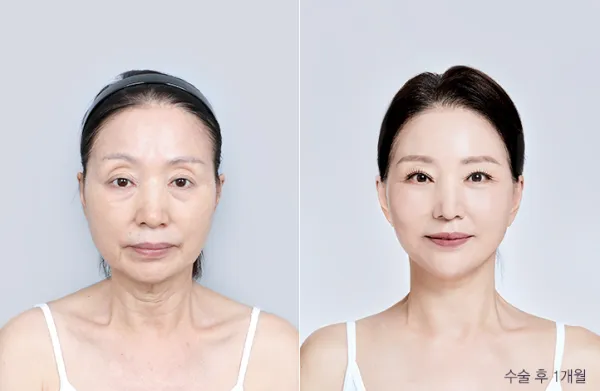 Before/After
