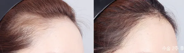 Before/After