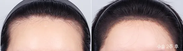 Before/After