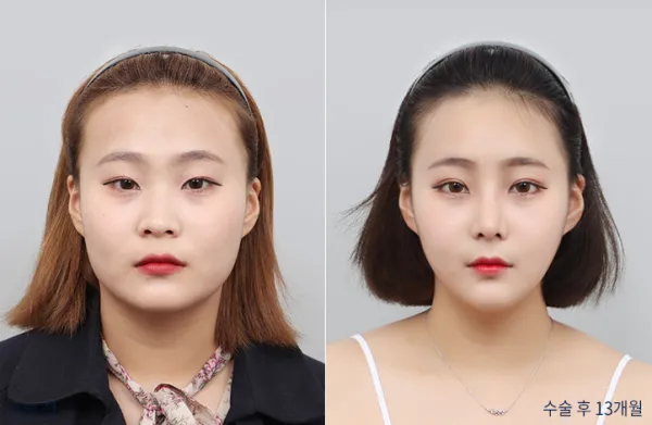 Before/After