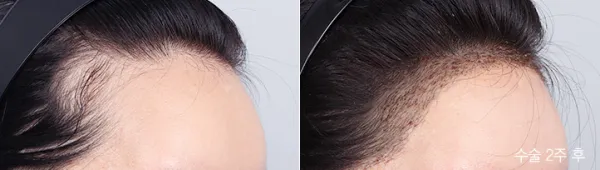 Before/After