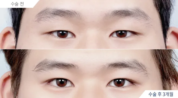 Before/After