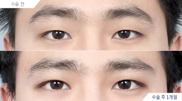 Before/After