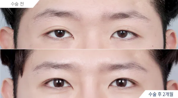 Before/After