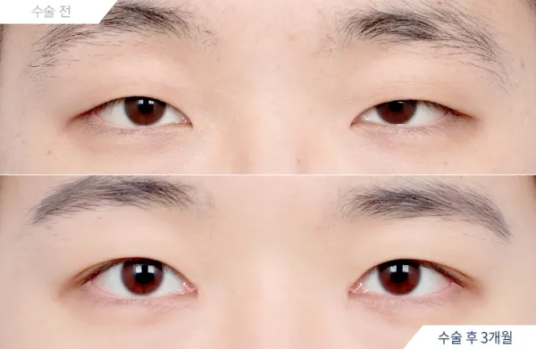 Before/After