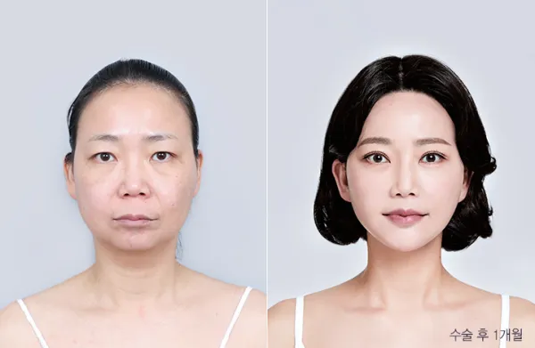 Before/After