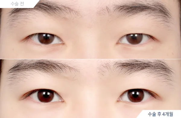 Before/After
