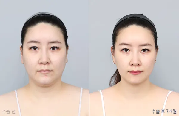 Before/After