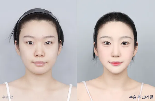 Before/After